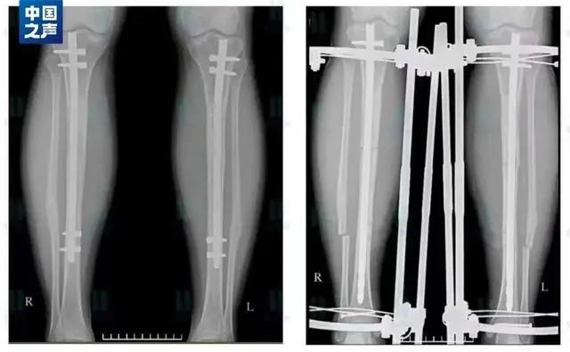 花高价做手术却落下伤病—— 什么是断骨增高术？