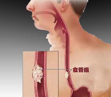 改变不良饮食习惯防食道癌