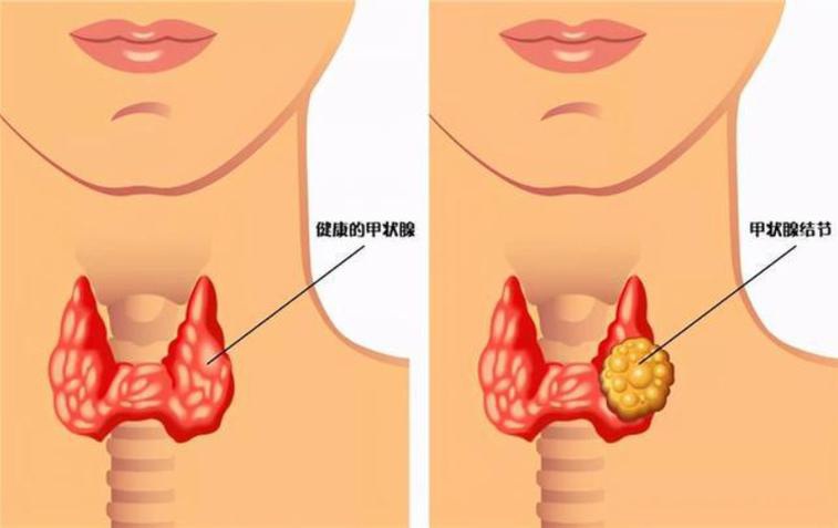 看懂甲状腺结节分类