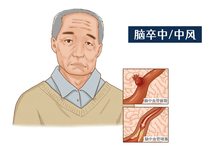 中西医结合 护理脑卒中