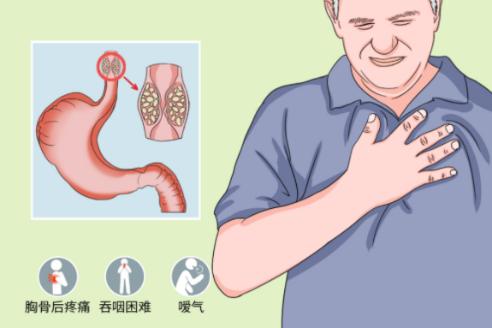 食管癌的早期预警信号是什么？