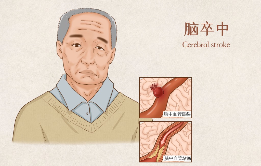 脑中风科普知识