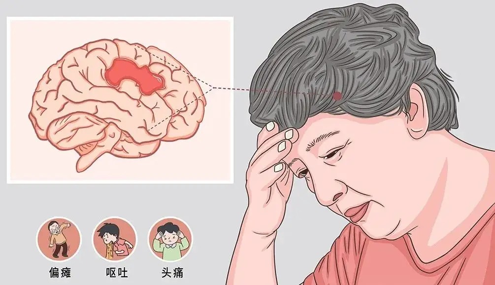 脑中风科普知识