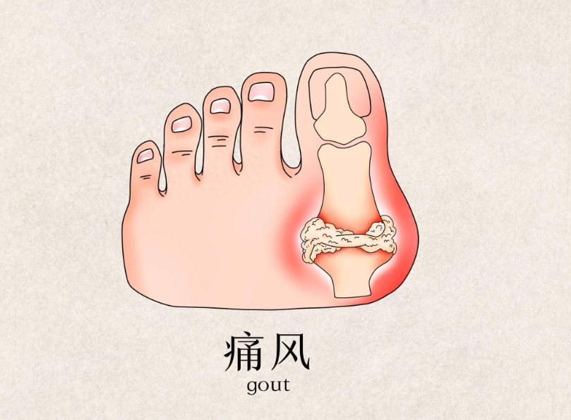 痛风用药过量易中毒