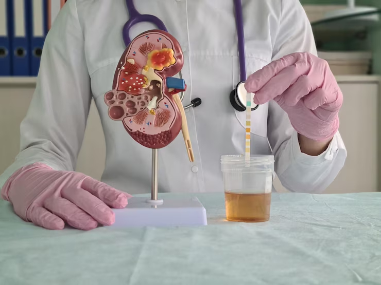 四点助你辨别蛋白尿