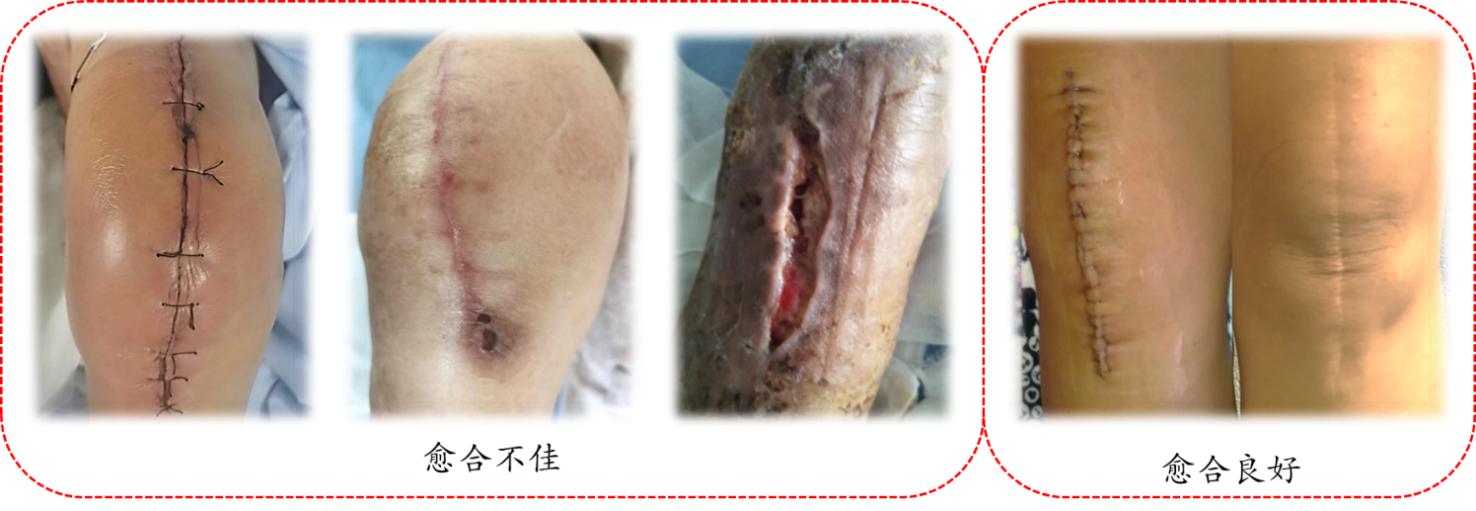 膝关节置换术后伤口护理科普小知识