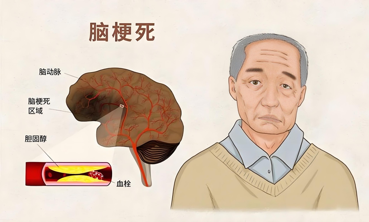 脑梗有五个祸根
