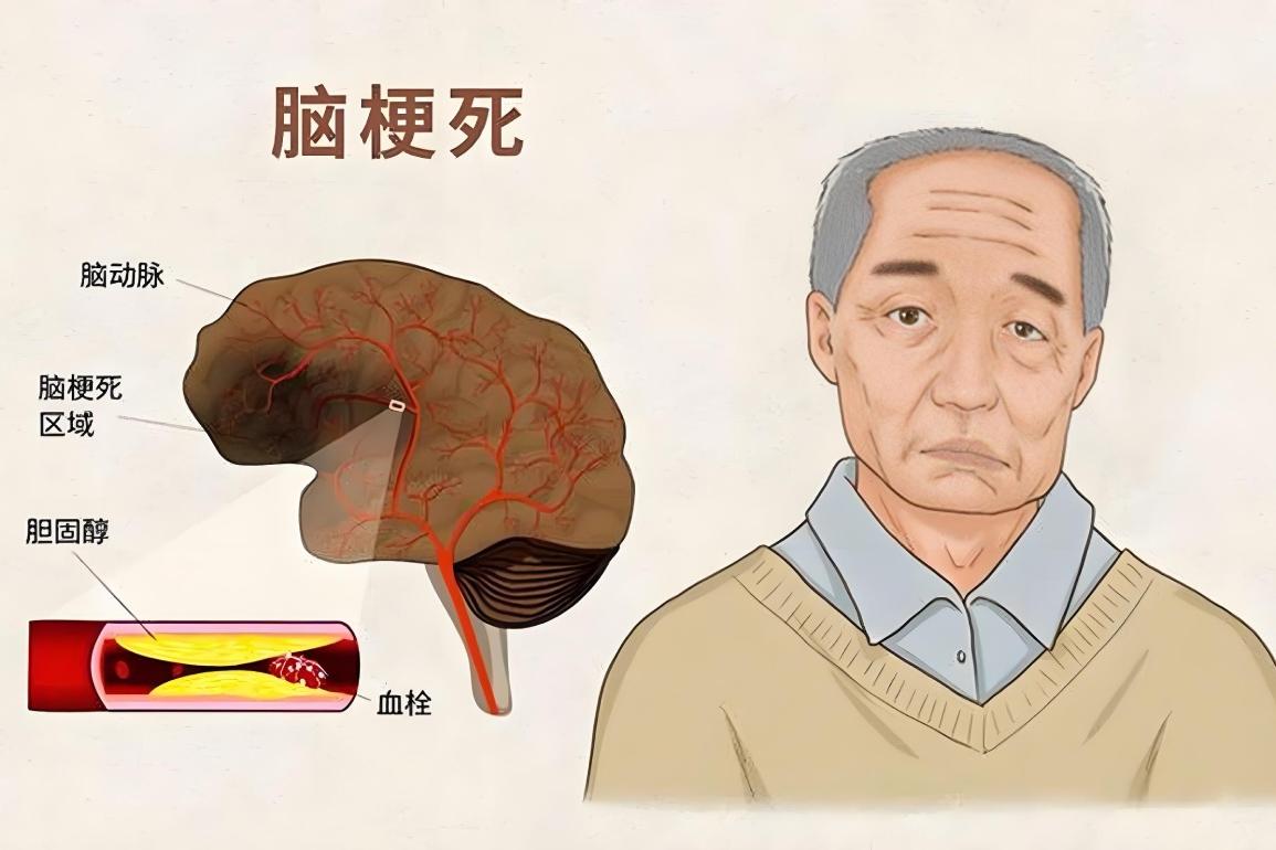 脑梗有五个祸根