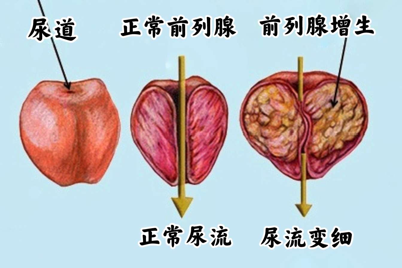 泌尿外科新知:如何预防和治疗前列腺肥大?