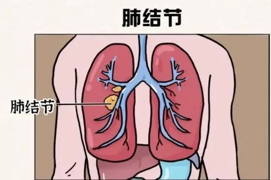 肺部结节不用怕，科学认知来解答