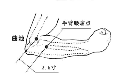 穴位按摩缓解带状疱疹后遗痛