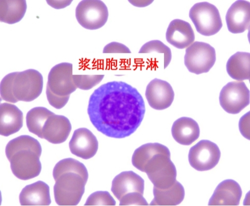 反应性淋巴细胞的分类及临床意义