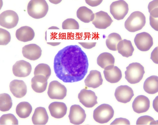 反应性淋巴细胞的分类及临床意义