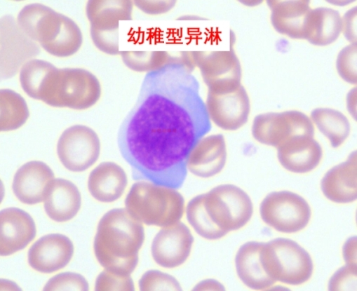 反应性淋巴细胞的分类及临床意义