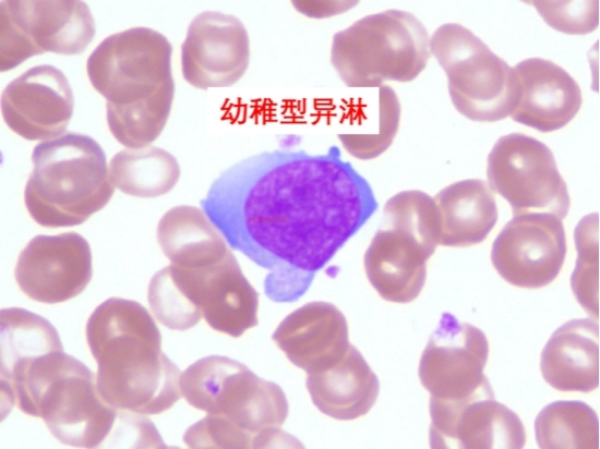 反应性淋巴细胞的分类及临床意义