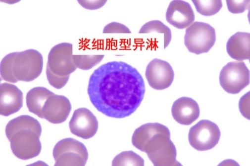 反应性淋巴细胞的分类及临床意义
