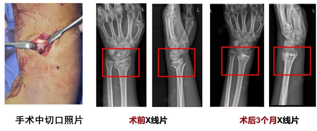 用“胶水”拯救粉碎性骨折—— “骨02”靠谱吗？