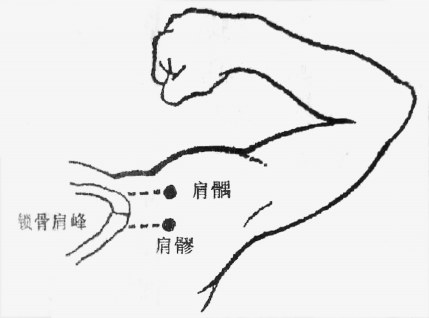 秋季高发五十肩 中医来防治