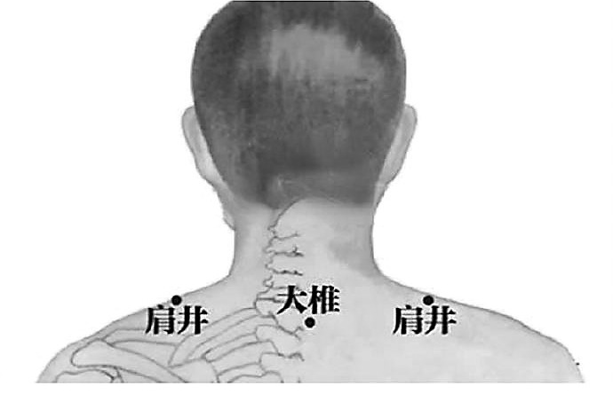 秋季高发五十肩 中医来防治