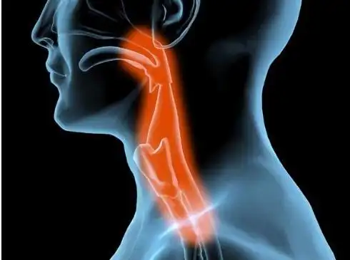 喉咙沙哑久不愈,小心咽喉肿瘤悄悄来敲门