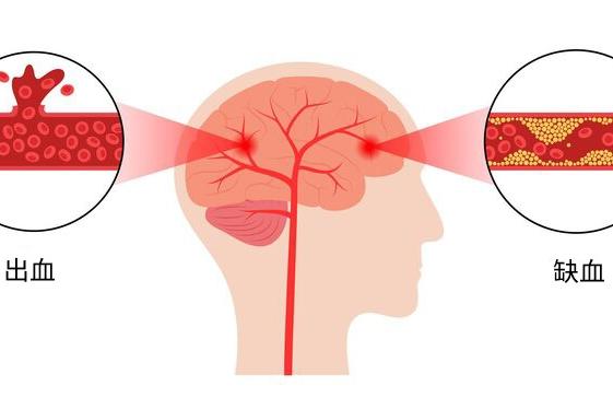 脑出血和脑梗塞不是一回事