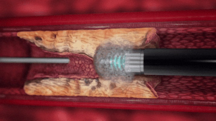 告别支架再狭窄，激光打通“心”通道