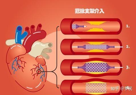 冠心病支架植入术后患者可以“停药”吗？