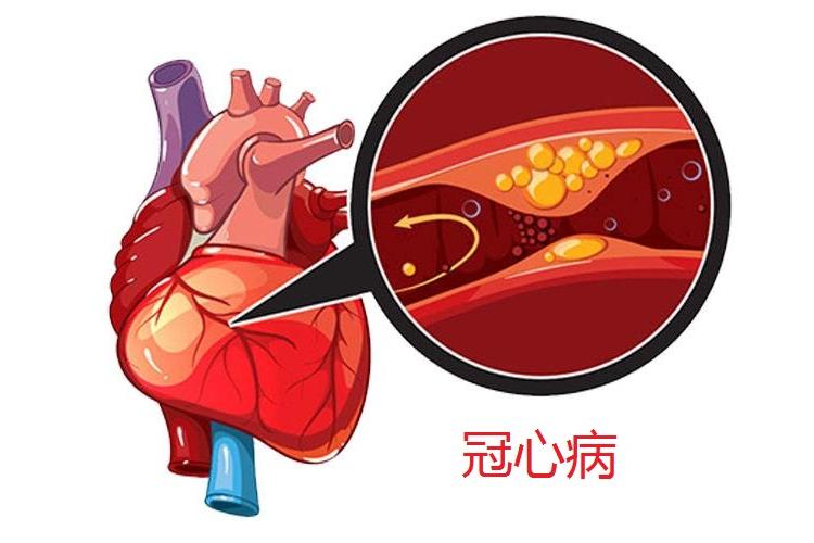 冠心病支架植入术后患者可以“停药”吗？