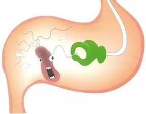 幽门螺杆菌阳性，到底要不要“杀”？治疗前必看的利弊权衡