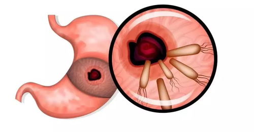 幽门螺杆菌阳性，到底要不要“杀”？治疗前必看的利弊权衡