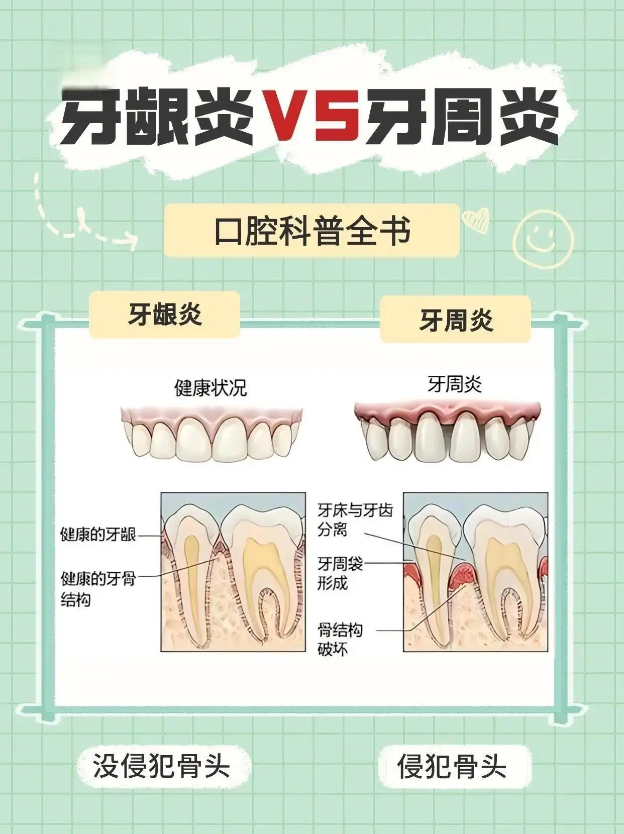牙龈出血不是上火 当心牙周炎“啃”你的牙根