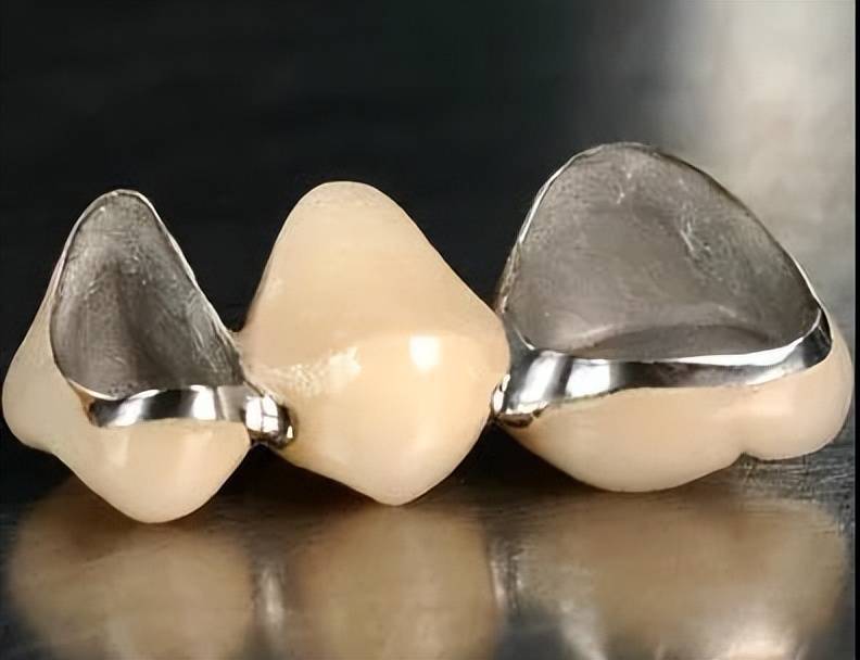 烤瓷牙和全瓷牙,谁是“颜值与耐用”的双料冠军?