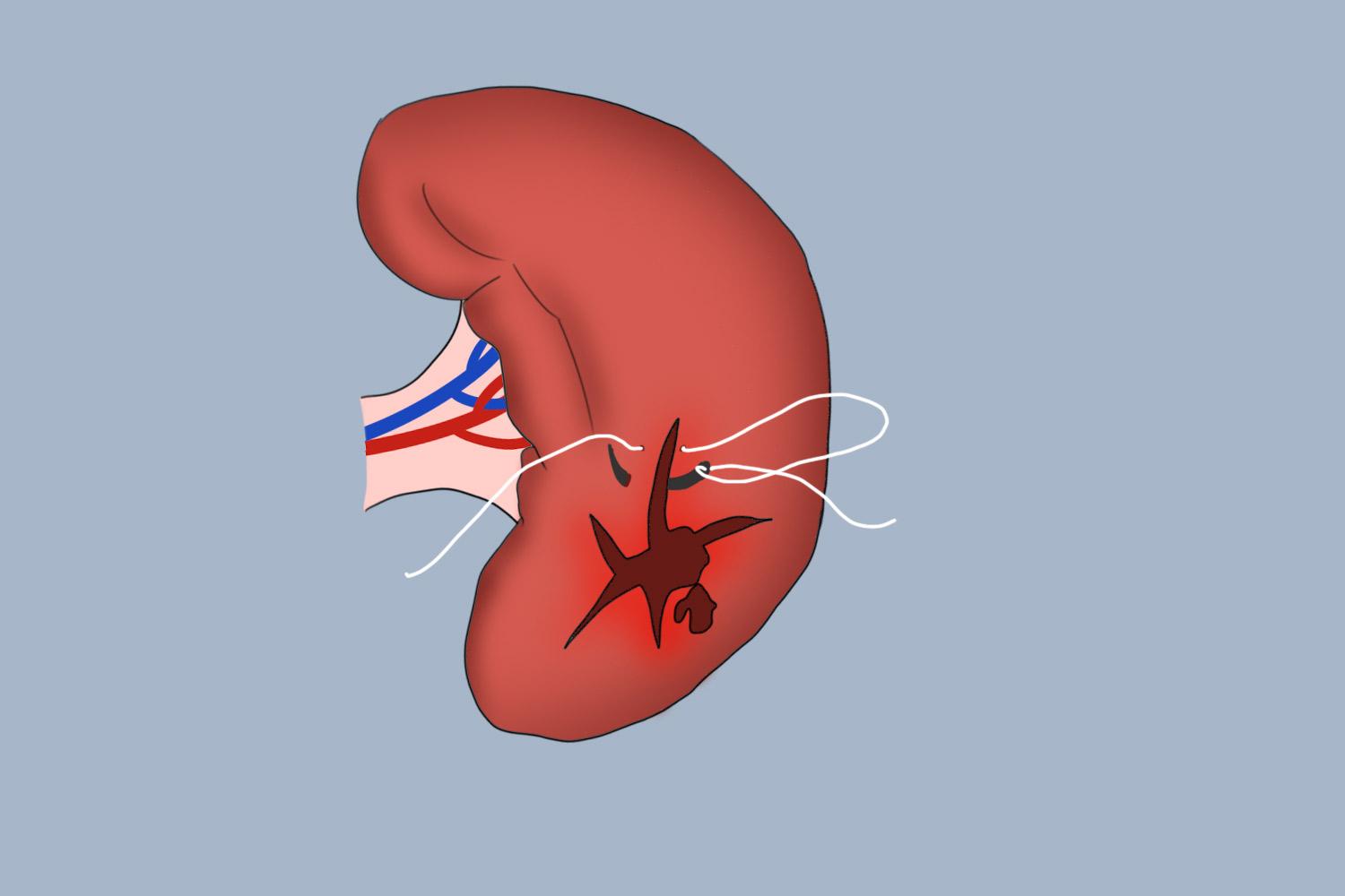 创伤性脾破裂，腔镜手术助快速康复